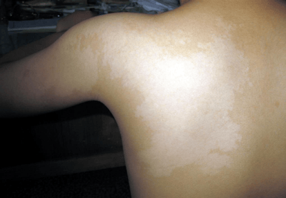 孩子身上发现白斑是不是白癜风？济南中医白癜风医院专家这么说