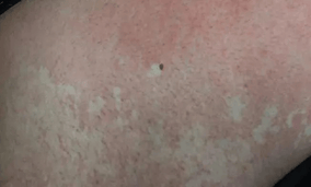 孩子身上发现白斑是不是白癜风？济南中医白癜风医院专家这么说
