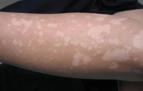 孩子身上发现白斑是不是白癜风？济南中医白癜风医院专家这么说