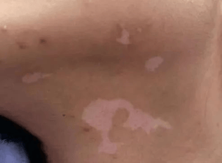 孩子身上发现白斑是不是白癜风？济南中医白癜风医院专家这么说